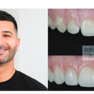 COMPOSITE BONDING - A hands-on course with Dr Teki Sowdani - Saturday 14th November 2026